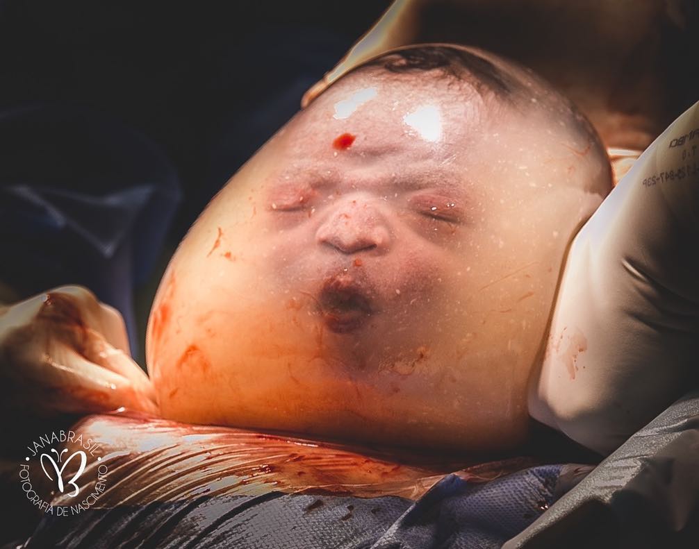 羊膜に包まれた赤ちゃん