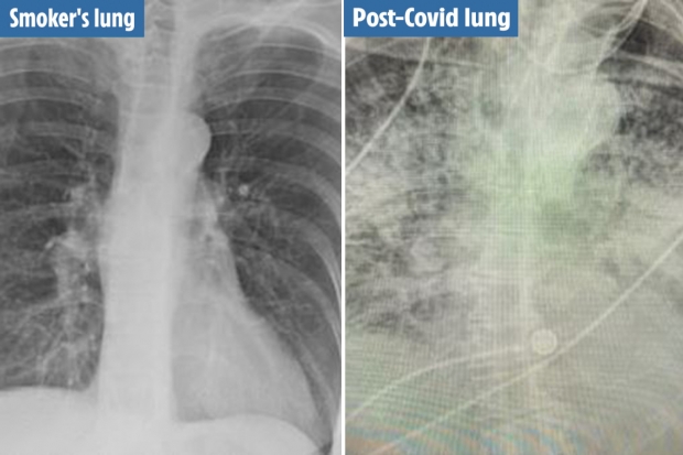 新型コロナウィルス患者の肺