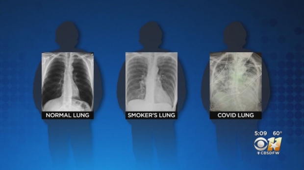 新型コロナウィルス患者の肺